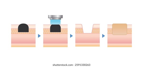 Vector illustration of cross section of skin being irradiated with laser