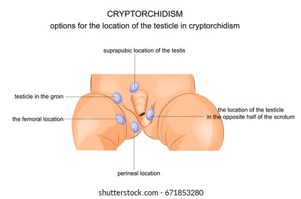 Vektorgrafik.Kryptorchidismus ist das Fehlen eines oder beider Hoden aus dem Skrotum. 