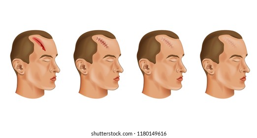 vector illustration of a cut head wound