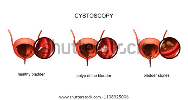 Vector Illustration Cystoscopy Bladder Stones Bladder Stok Vektör Telifsiz 1108925006 7495