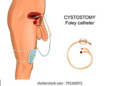 vector illustration of cystostomy. Foley catheter. surgery