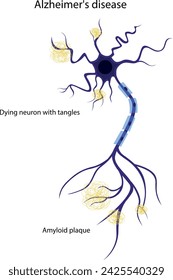 Vector illustration of a damaged neuron. The structure of a diseased neuron. Alzheimer's disease. Brain disease dementia, memory disorders.
