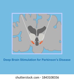 Vector illustration of deep brain stimulation at subthalamic nucleus for the treatment of parkinson's disease.
