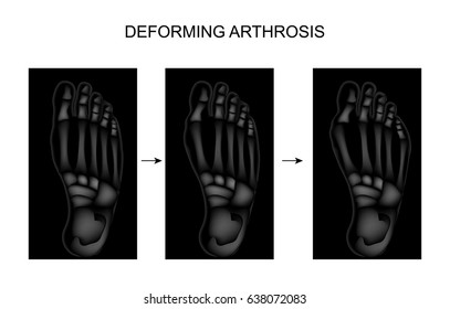 vector illustration of deforming arthrosis of the foot