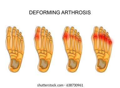vector illustration of deforming arthrosis of the foot. the skeleton of the foot

