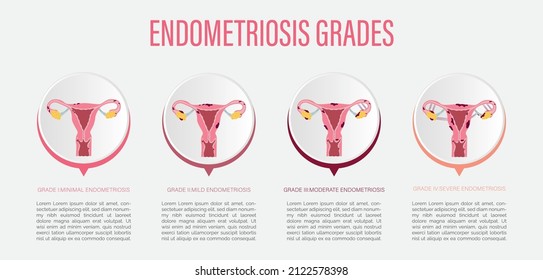 Ilustración Vectorial De Grados De Endometriosis Vector De Stock Libre De Regalías 4938