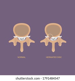 Vector illustration demonstration of axial view of herniated lumbar disc. Lumbar disc herniation can cause low back pain and sciatica