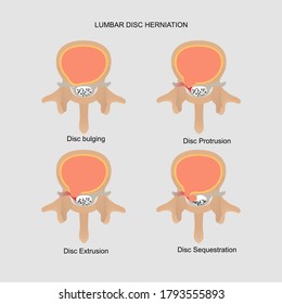 Vector illustration demonstration of axial view of herniated lumbar disc. Degree of lumbar disc including disc bulging, protrusion, extrusion,sequestration.