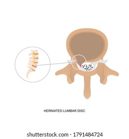 Vector illustration demonstration of human herniated lumbar disc. Lumbar disc herniation can cause low back pain and sciatica