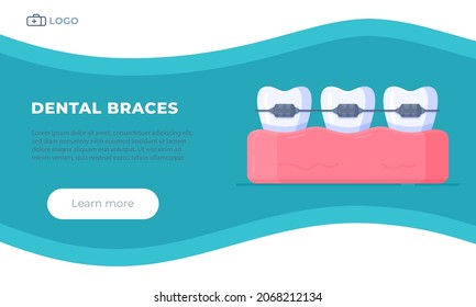 Vector illustration of dental braces. Alignment of teeth. 