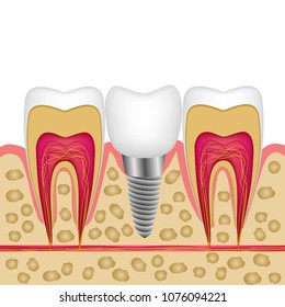 Vector illustration of a dental implant in bone between teeth for booklets, magazines, flyers, banner, website of a dental clinic.