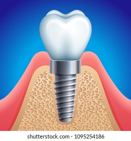 Vector illustration - dental implant icon