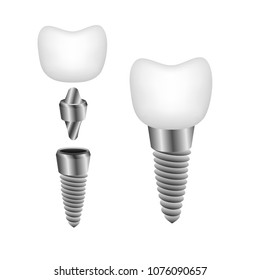 Vector illustration of dental implant for promotional booklets, posters, flyers, banner, website of dental clinic.