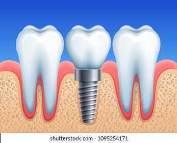 Vector illustration - dental implant and teeth