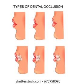 vector illustration of a dental occlusion. dentistry
