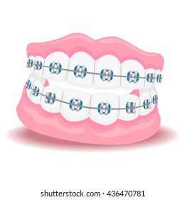 Vector Illustration of Dentures with Braces