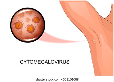 Vector illustration for dermatology. Increase under the microscope. for medical brochures, magazines and books.
