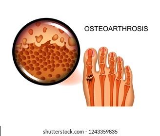 vector illustration of the destruction of the joint of the big toe in arthrosis