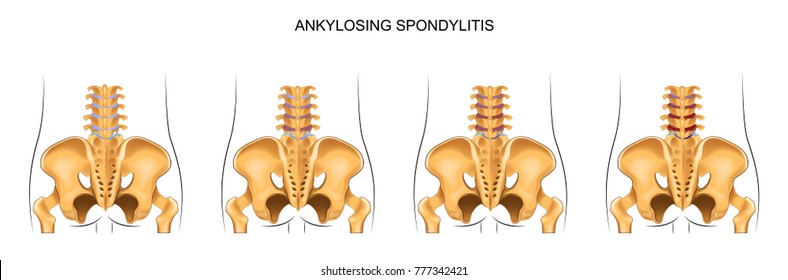 vector illustration of the development of ankylosing spondylitis in the lumbar spine