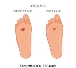 Vector illustration. Diabetic foot with not infected ulcer and diabetic foot with infected ulcer. Bottom view, sole. EPS 10. Blend mode and transparency was used.