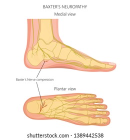 Vector illustration, diagram of the Baxter's neuropathy problem, inflammation of the inferior calcaneal nerve. Medial and plantar view of a human foot.