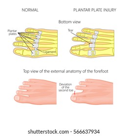 Vector illustration (diagram). Deviation of the toe. Mechanism of rupture of plantar plate of the seond toe of the foot. External and skeletal views of an ankle.