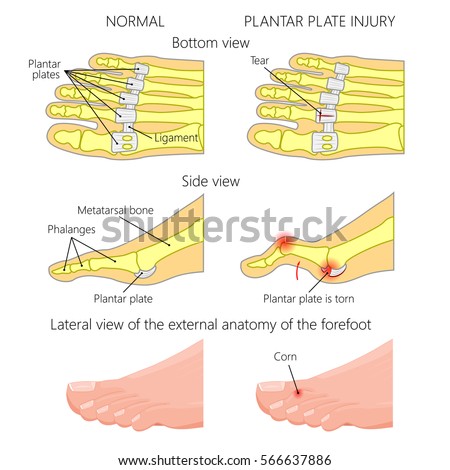 Vector illustration (diagram). Hammer toe. Plantar plate injury. Mechanism of rupture of plantar plate of the second toe of the foot. External and skeletal views of an ankle.