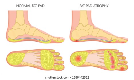 Vector illustration, diagram of a healthy foot and a foot with a fat pad atrophy. Medial and plantar view of a human foot.
