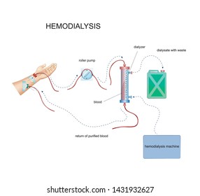 vector illustration of diagram of hemodialysis