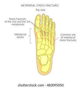 674 Foot stress fracture Images, Stock Photos & Vectors | Shutterstock