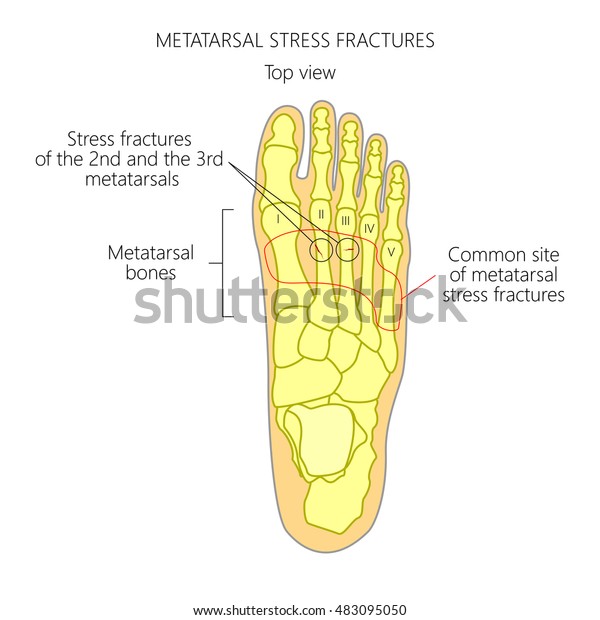 Vector Illustration Diagram Metatarsal Stress Fractures Stock Vector Royalty Free 483095050 4536