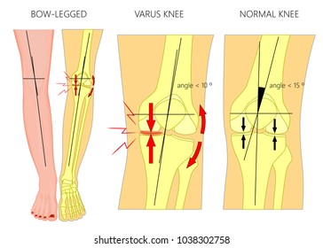 Vector illustration diagram. Shapes of human legs. Normal and curved legs. Knock knees. Bowed legs. Genu valgum and genu varum.  For advertising, medical publications. EPS 10.