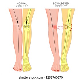 Vektorgrafik. Formen menschlicher Beine. Normale und gekrümmte Beine. Knochenknie. Verbeugte Beine. Genu valgum und Genu varum.  Für die Werbung, medizinische Veröffentlichungen. EPS10.