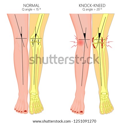 Vector illustration diagram. Shapes of human legs. Normal and curved legs. Knock knees.  Genu valgum and genu varum.  For advertising, medical publications. EPS 10.