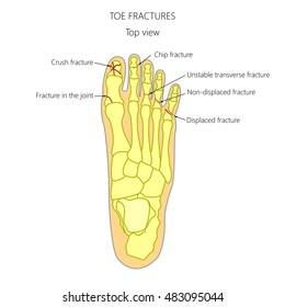 Vector illustration (diagram) of toe fracture types.