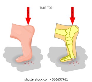 Vector illustration (diagram).Turf toe. Sport trauma. Mechanism of rupture of plantar plate of the first toe of the foot. External and skeletal views of an ankle. Used: blend.
