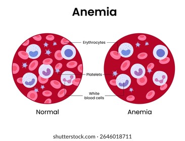 Ilustração vetorial da diferença do número de glóbulos vermelhos saudáveis. Anemia e normal.	