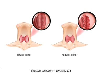 Vector Illustration Of Diffuse And Nodular Goiter, The Thyroid Gland Is A Sectional View