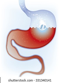Vector illustration of digestive problems