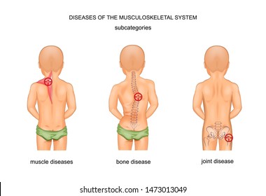 vector illustration of diseases of the musculoskeletal system