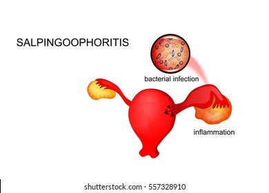 vector illustration of diseases of the reproductive system for publications in medical brochures and magazines
