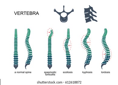 vector illustration of diseases of the spine.vertebrae