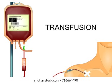 vector illustration of a donor blood transfusion to the patient through the subclavian catheter