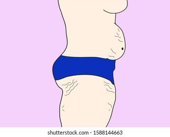 Vector illustration doodle drawing of people with overweight and has fat belly and broken skin problems, stretched skin sketch.
