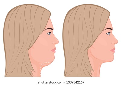 Vector illustration of a double chin removal. For advertising of plastic surgery, medical and beauty publications