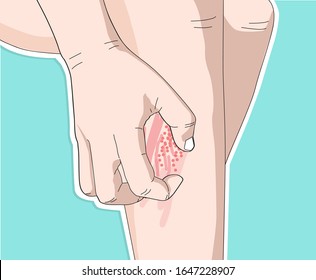 vector illustration drawing of body with scratching hand on legs with itchy and have red rashes, sensitive skin and dermatitis or skin diseases.