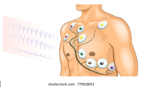 Vector Illustration Of ECG Electrodes On The Chest Of The Athlete
