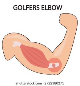 Vector illustration of golfer’s elbow showing inner elbow pain, stiffness, weakness, tingling, and related conditions like tendonitis and nerve entrapment. And icon