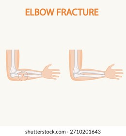 Vector illustration of an elbow showing pain, swelling, and stiffness. Highlights symptoms of tendonitis and bursitis, with visuals distinguishing these from similar joint conditions hand bone