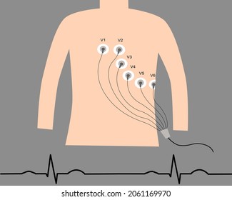 Vector illustration of the electrocardiogram. ECG or EKG electrodes on chest patient with Normal electrocardiogram pattern.